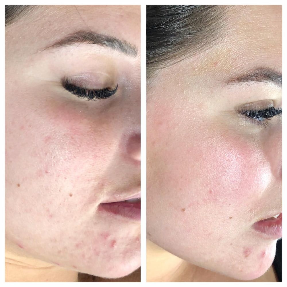 Before and After Photos of a Woman's Face, Showing Acne and Improved Skin Clarity — Eternal Radiance in Strathmore, VIC