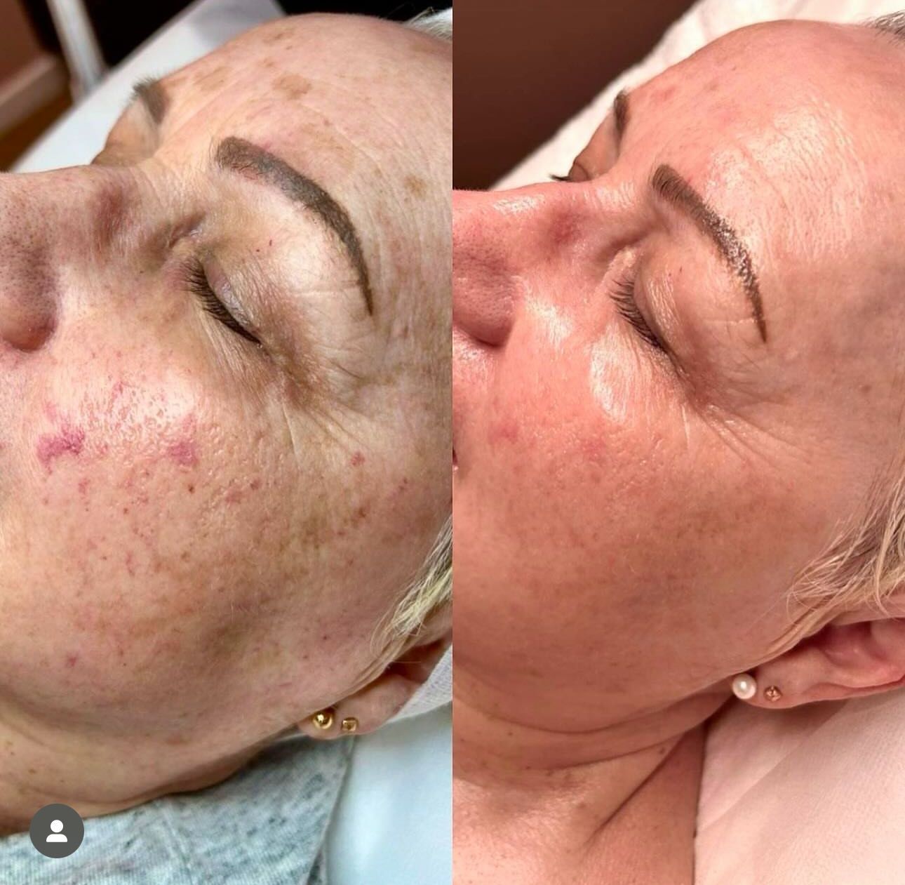 Woman's Face, Before/after View; Rosacea Treatment Results — Eternal Radiance in Strathmore, VIC