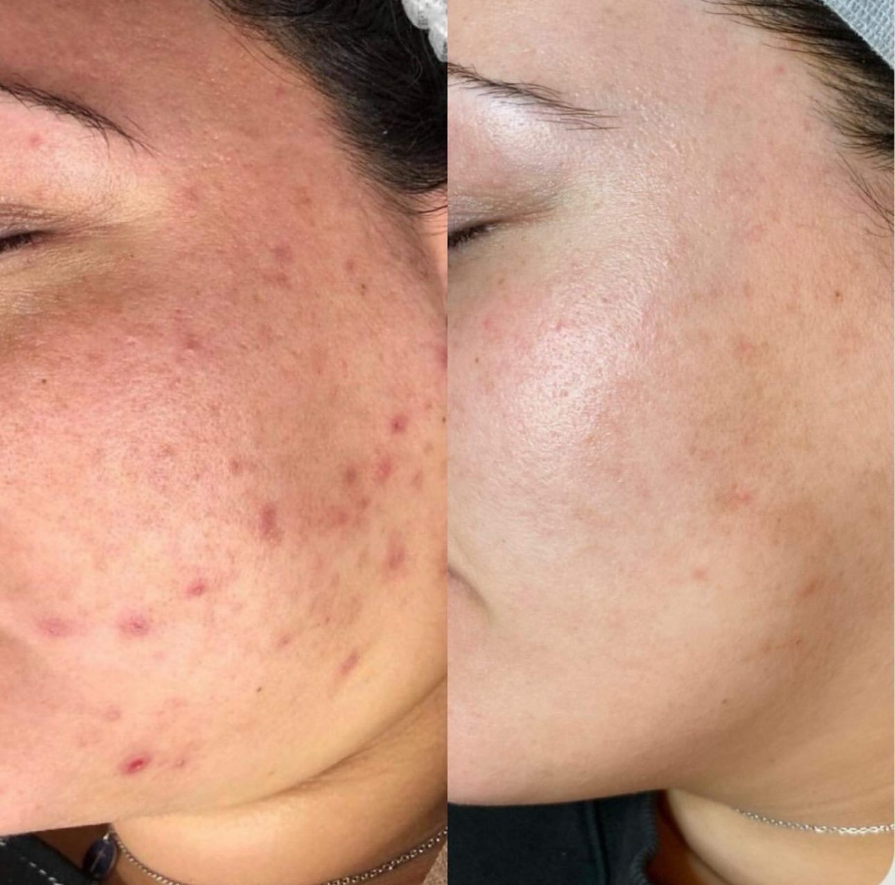 Woman Receiving Microneedling Facial Treatment, Eyes Closed, in a Spa Setting — Eternal Radiance in Strathmore, VIC