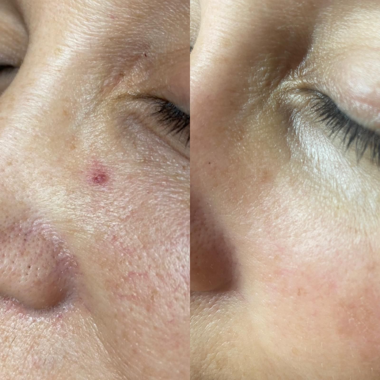 Side-by-side Faces of a Woman With Freckles — Eternal Radiance in Strathmore, VIC