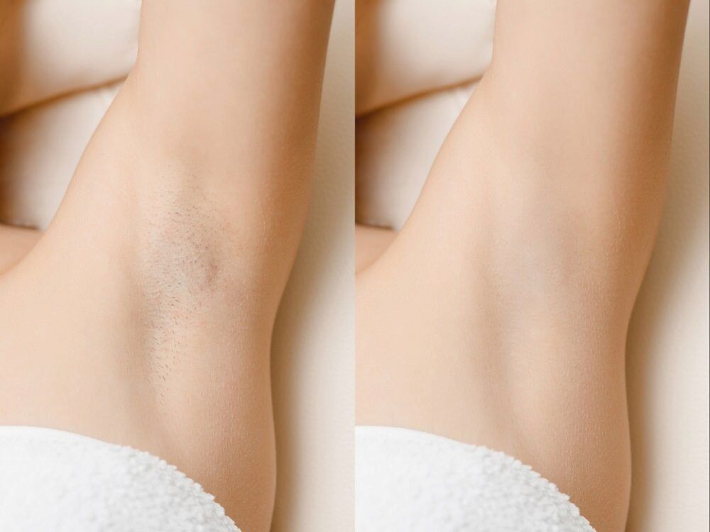 Before and After Armpit Comparison Showing Hair Removal — Eternal Radiance in Strathmore, VIC