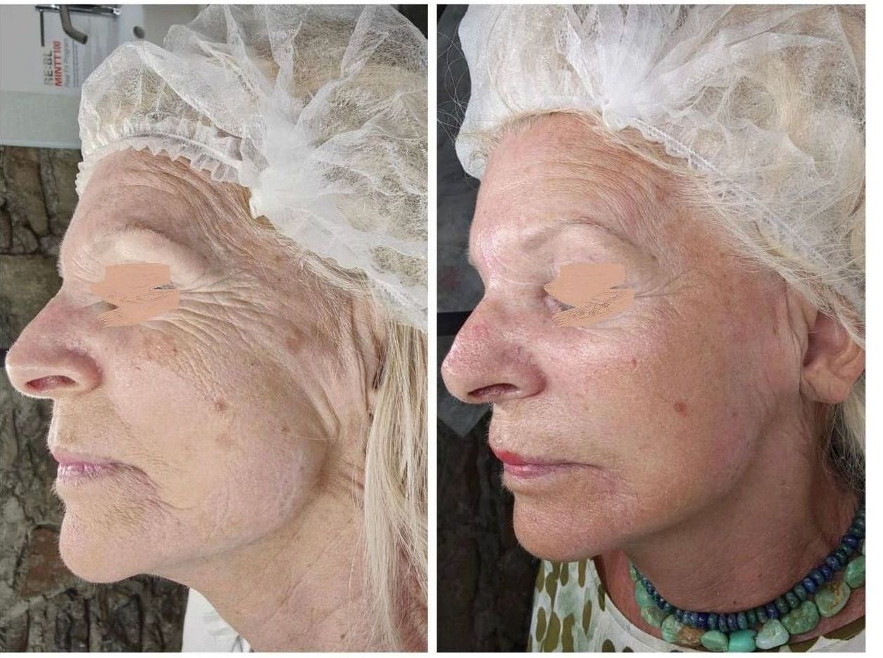 prima e dopo viso di profilo