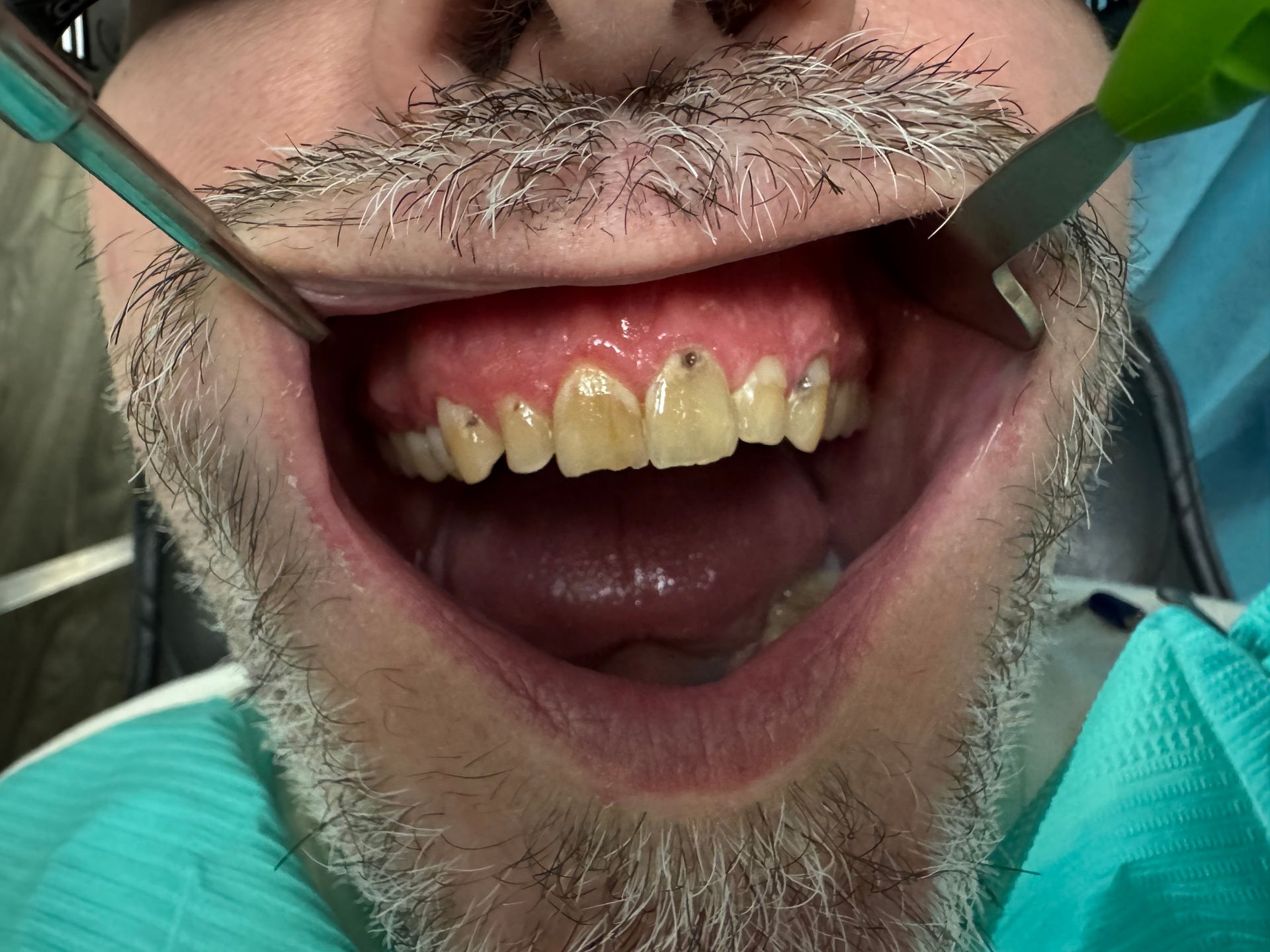 Resin veneers BEFORE & ATFER