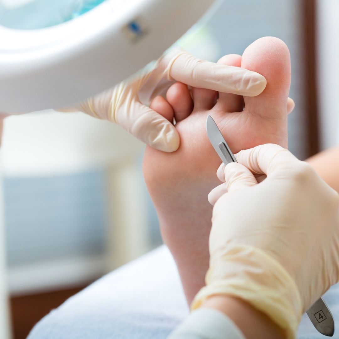 A person is getting a foot treatment with a scalpel.