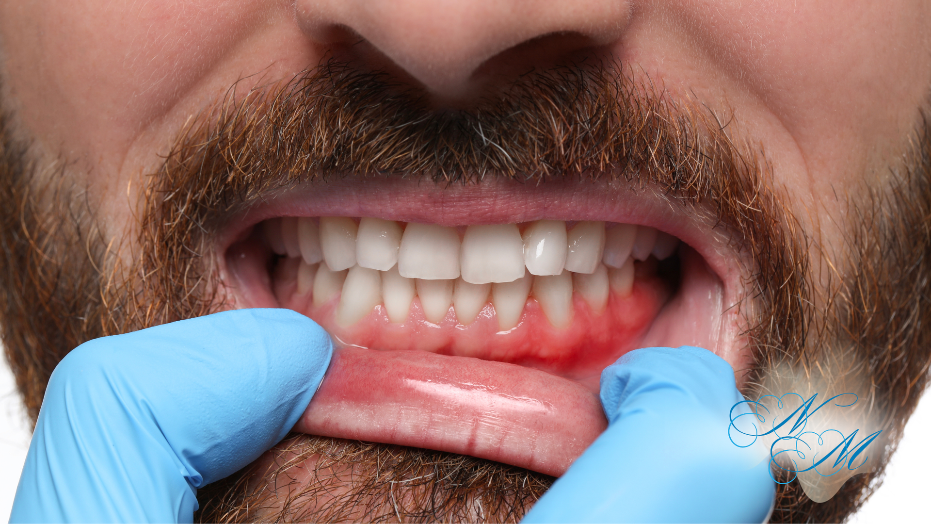 Mouth open, showing gums and teeth; gloved hand pulls lip down. Gums appear inflamed.