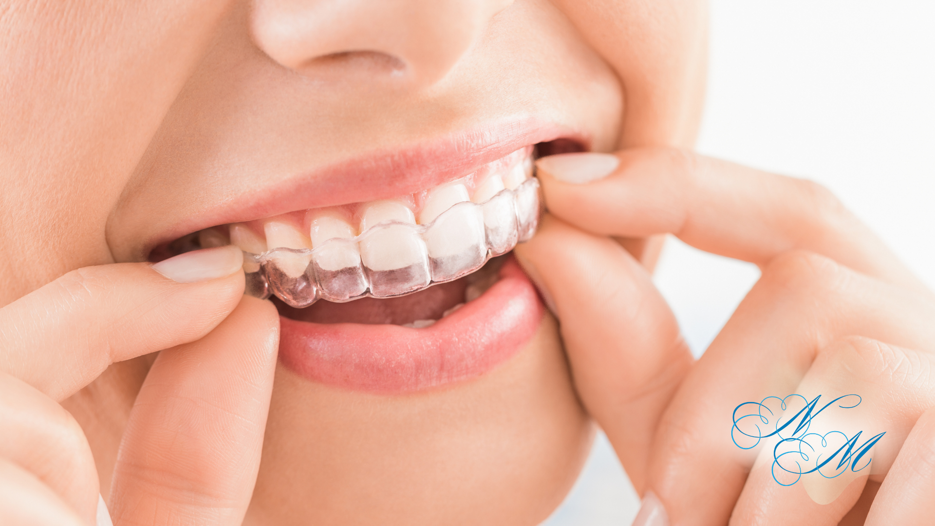 Person inserting clear aligner into mouth.