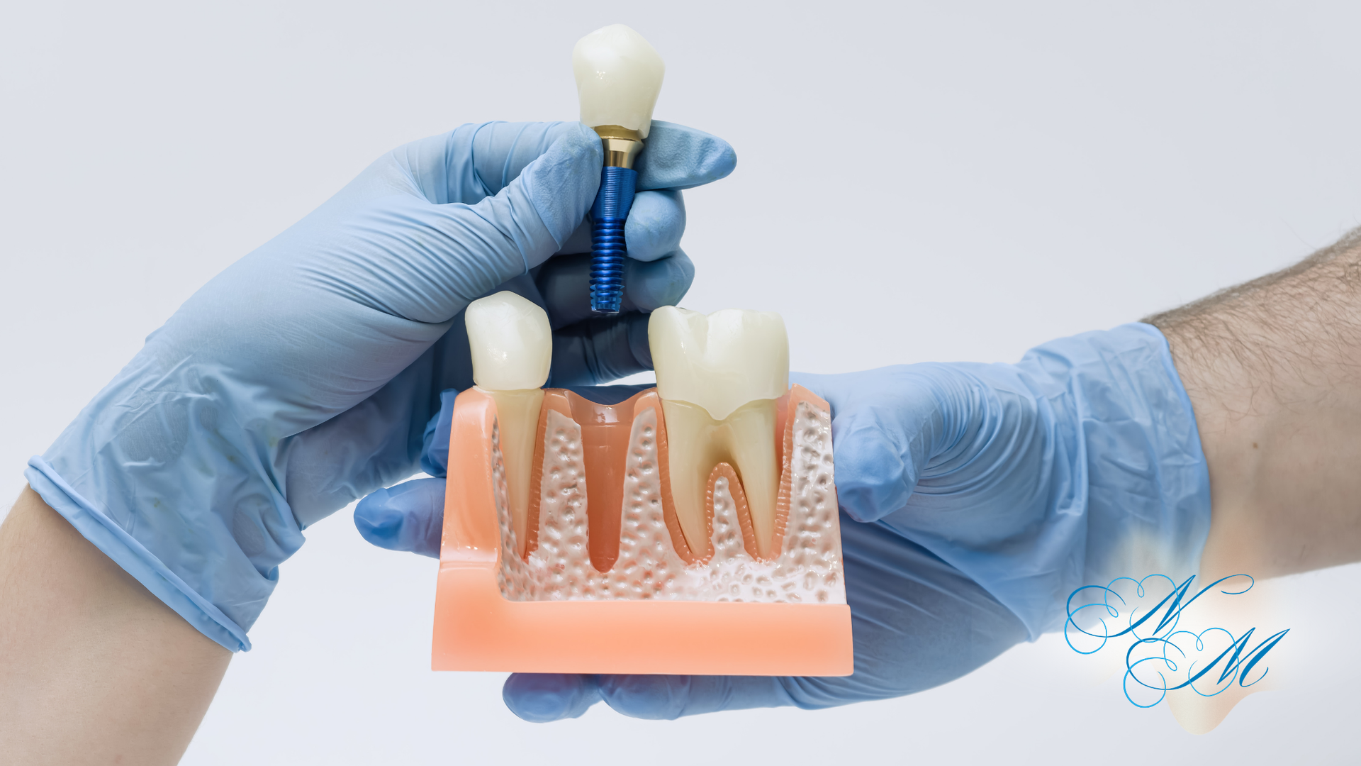 Gloved hands holding a dental implant model with three artificial teeth on a pink gum base