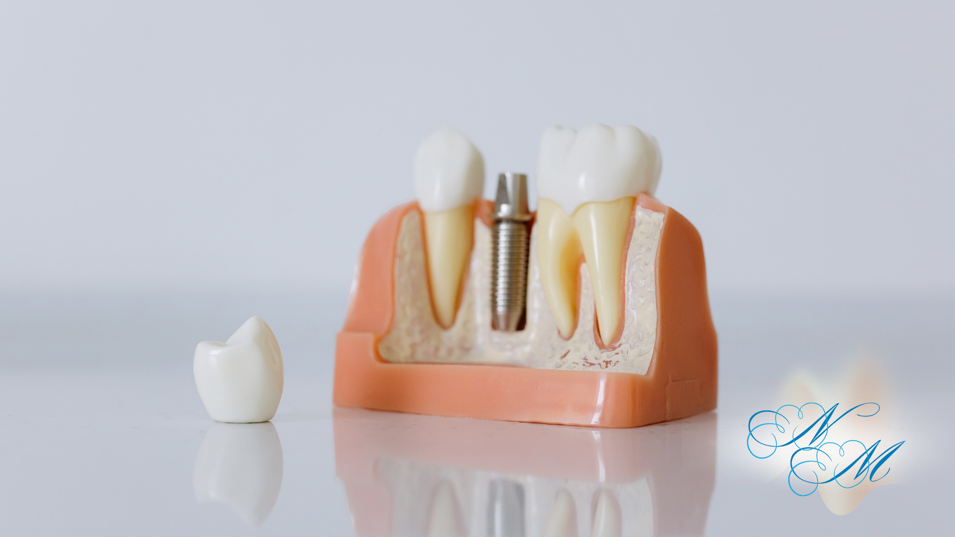 Dental implant model with tooth and crown, showing a cross-section of the jaw and teeth.