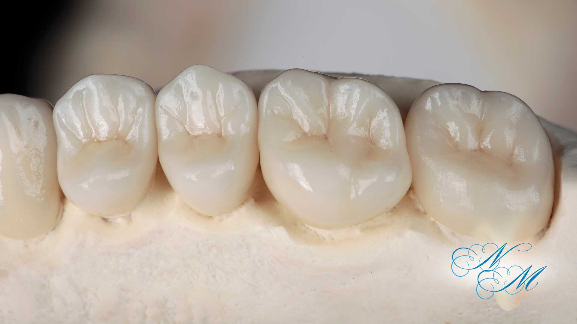 Close-up view of dental crowns on a model. The teeth are white and pearly.