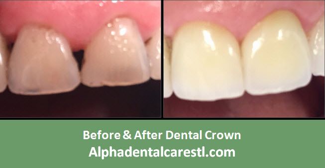 Before & After Dental Crown Example 1, Alpha Dental Care, St. Louis