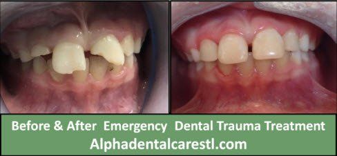 dental trauma - before and after treatment