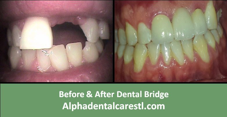 Bridges Before & After, Alpha Dental Care in St. Louis