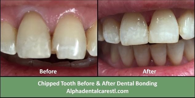 Dental Bonding Before and After, Alpha Dental Care St. Louis