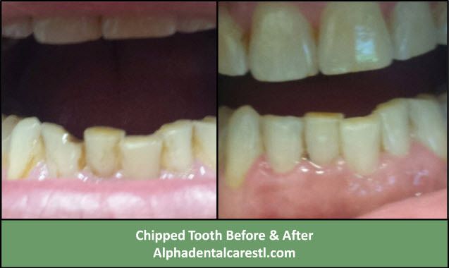 Chipped Tooth Before and After Dental Bonding, Alpha Dental Care