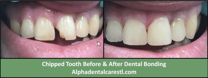 chipped tooth before and after dental bonding, Alpha Dental Care in St. Louis MO