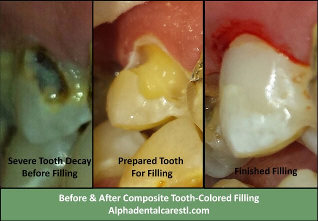 Severely Decayed Tooth Before and After Composite Tooth Colored Filling, Alpha Dental Care