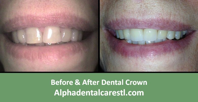 Before and After Dental Crown Example2, Alpha Dental Care in St. Louis