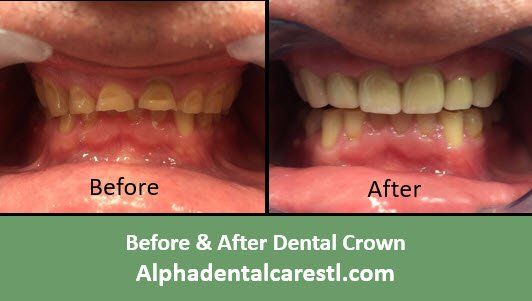 Before & After Dental Crown Example 3, Alpha Dental Care, St. Louis