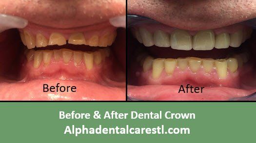 Before and After Dental Crown Example4, Alpha Dental Care in St. Louis