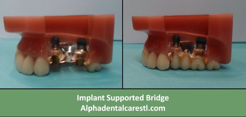 Implant Supported Bridge, Alpha Dental Care St. Louis MO