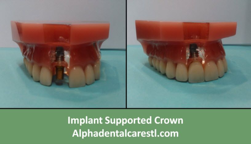 Implant Supported Crown, Alpha Dental Care St. Louis MO