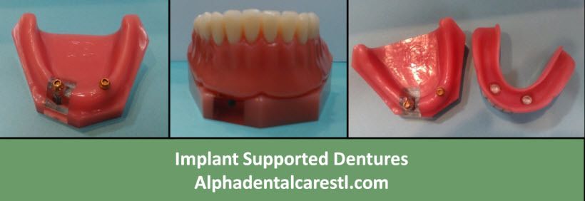 Implant Supported Dentures, Alpha Dental Care St. Louis MO