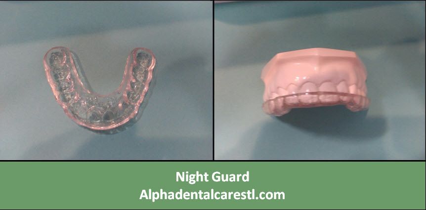Night Guard, Alpha Dental Care St Louis