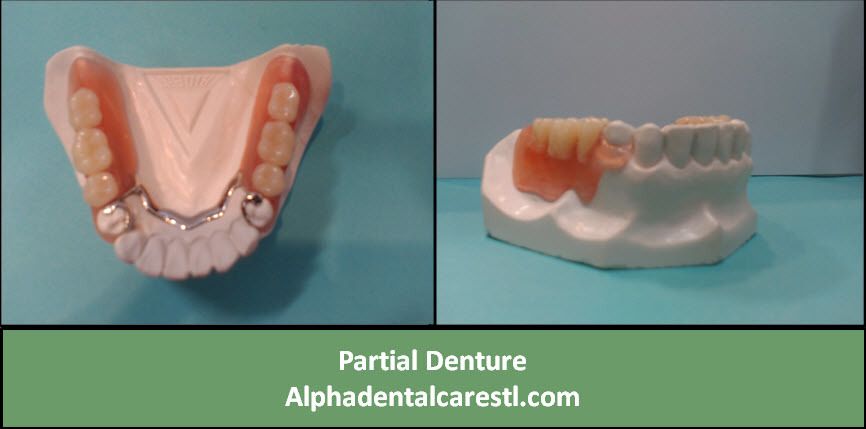 Partial Denture, Alpha Dental Care St. Louis MO
