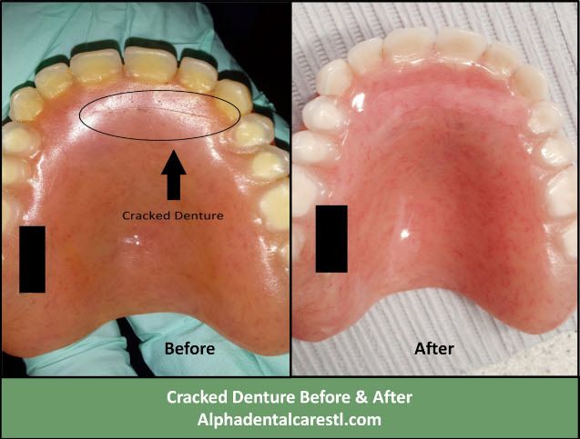 Broken Denture Before and After, Alpha Dental Care
