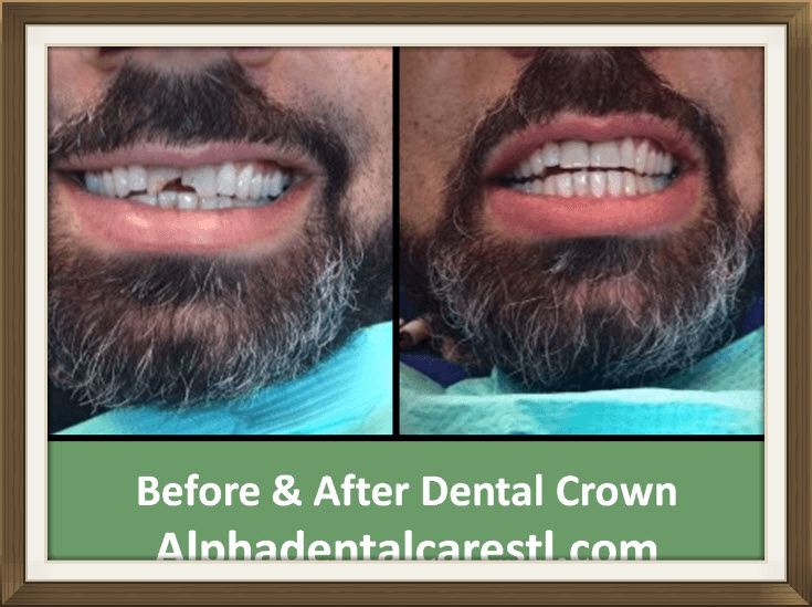 , Dental Crown, Alpha Dental Care in St. Louis MO