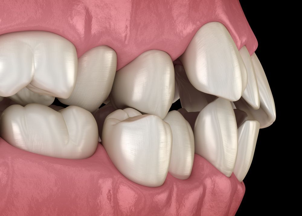 Side view of a mouth with crowded, misaligned teeth and pink gums