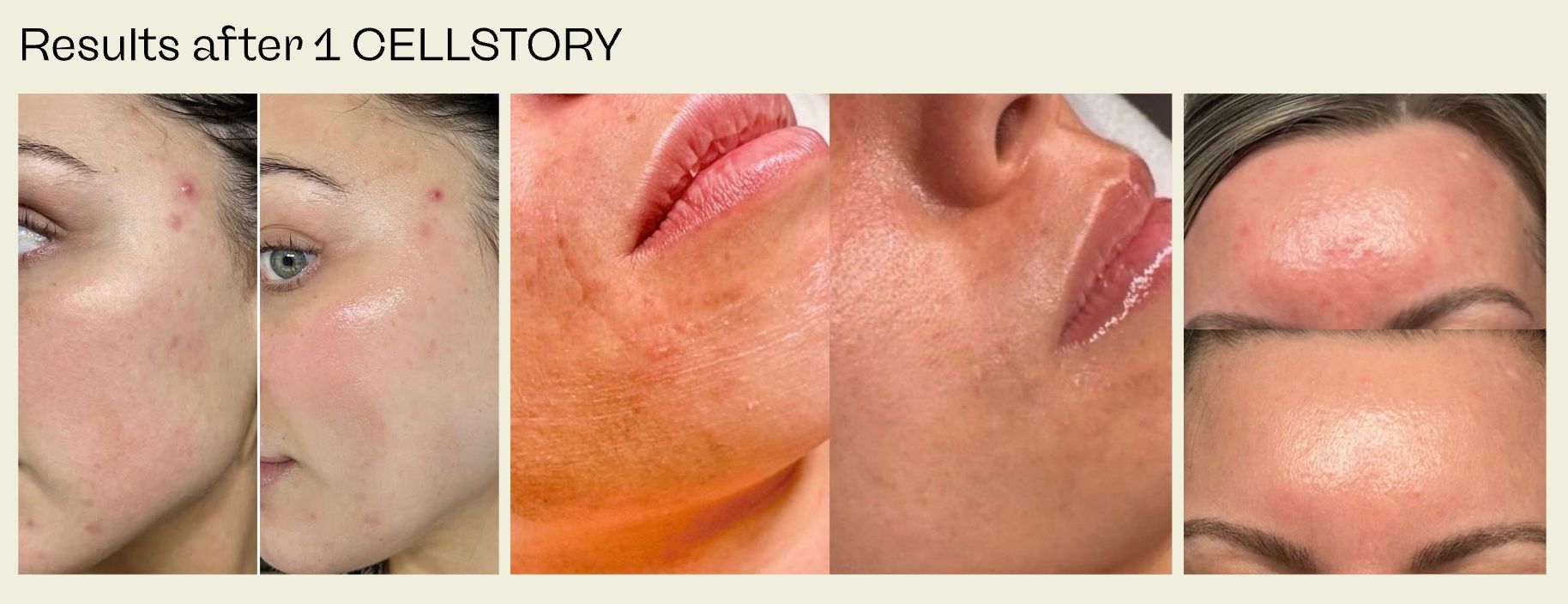 Before and after images of skin with acne, showing improvement after treatment.