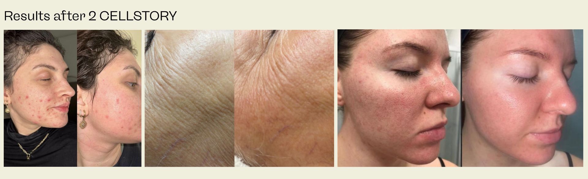 Before-and-after photos of faces, showing skin with acne and redness improving.