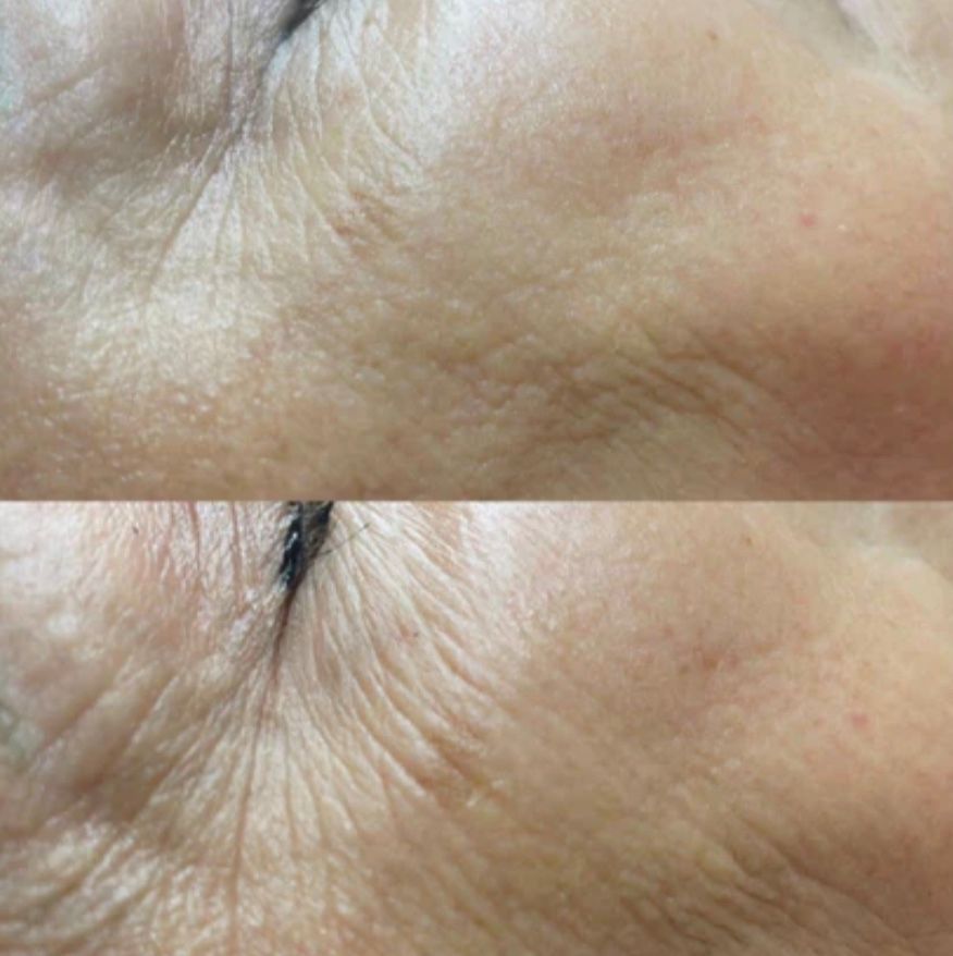 Top: Close-up of wrinkled skin near eye. Bottom: Smoother skin in the same area after treatment.