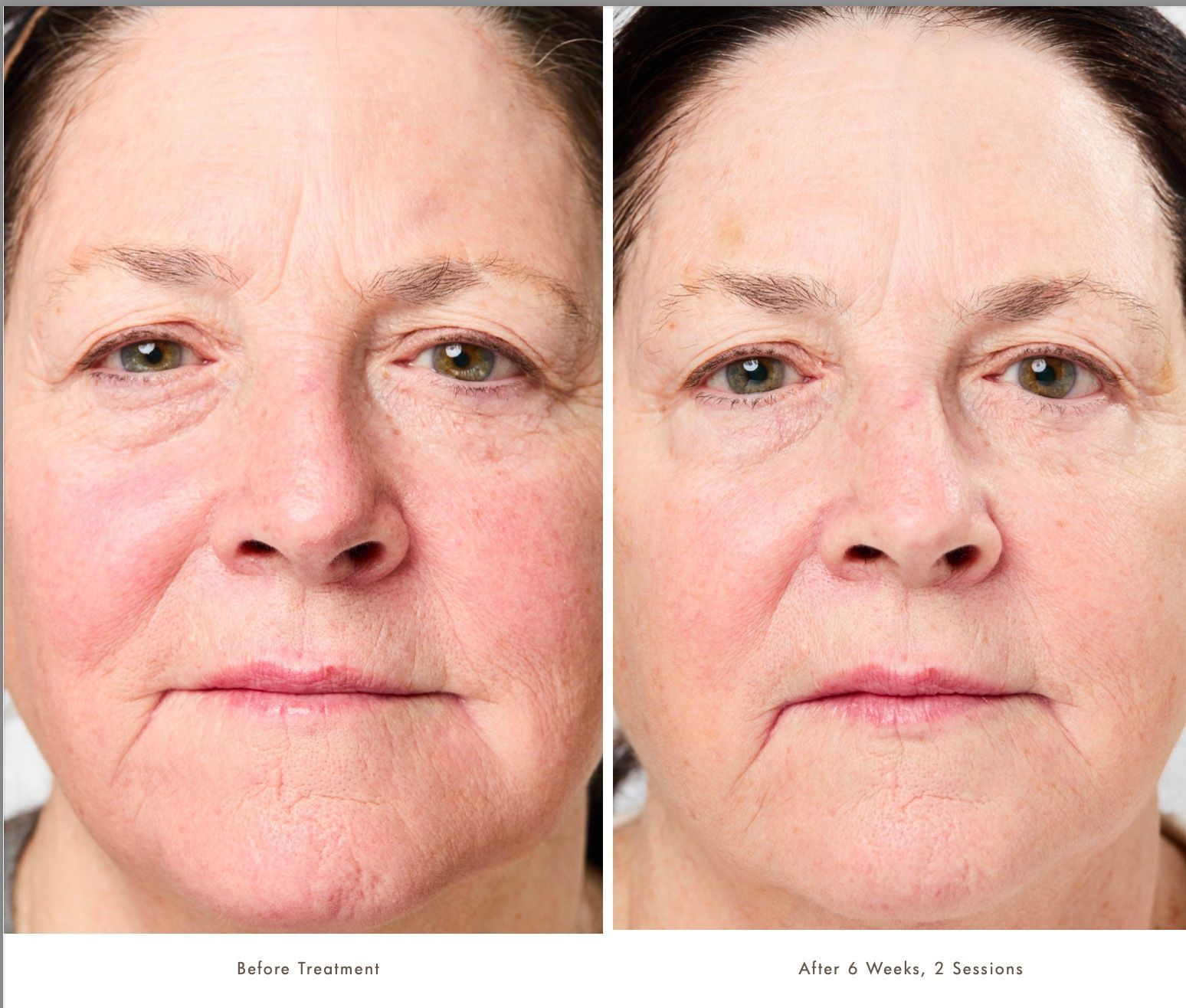 Before and after comparison of a person's face showing skin texture and tone improvement following a cosmetic treatment.