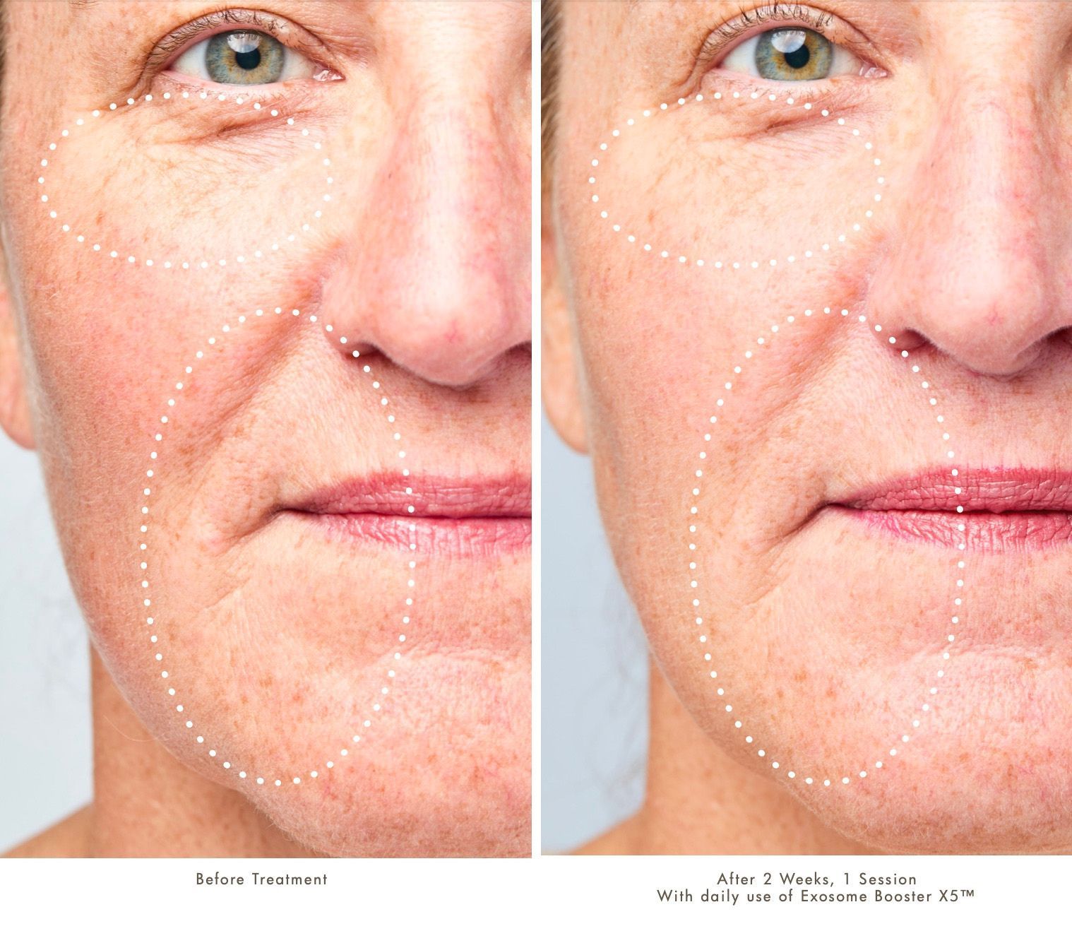 Before and after comparison of a person's face showing reduced fine lines around the eyes and mouth after skin treatment.