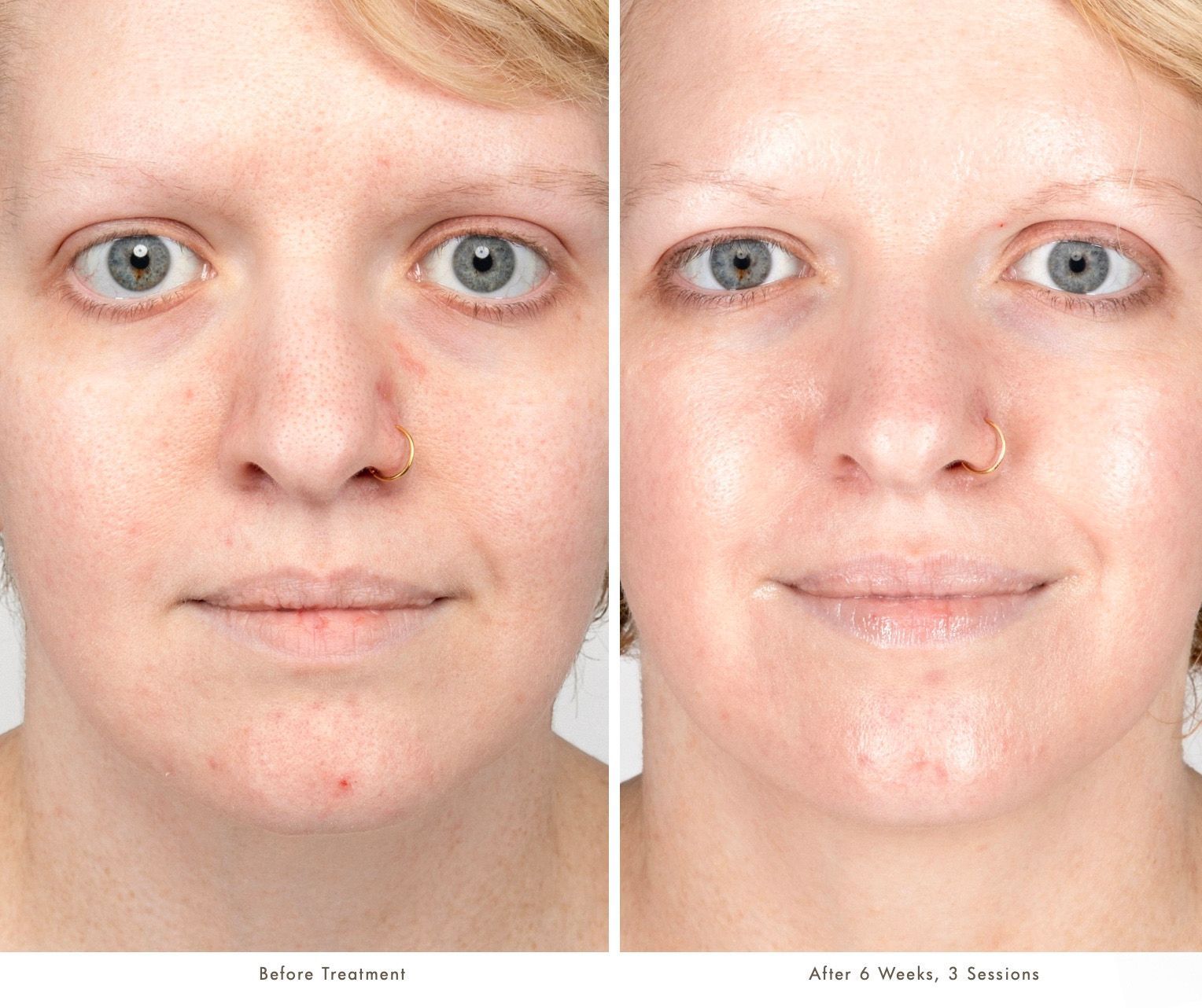 Before-and-after comparison of skin tone and texture improvement after three treatment sessions.