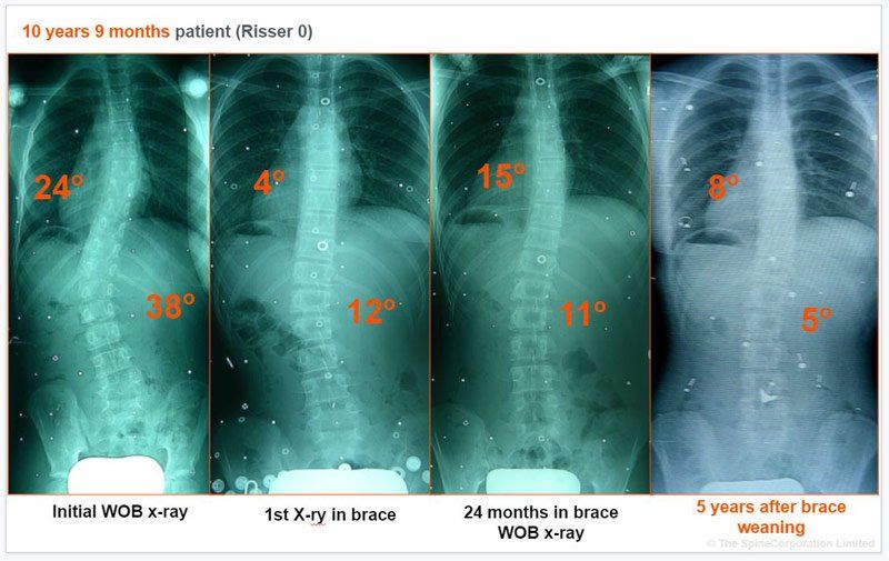 dual curve scoliosis spine x-rays