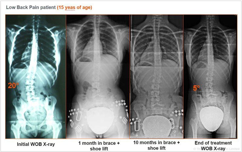 lower curve scoliosis spine x-ray
