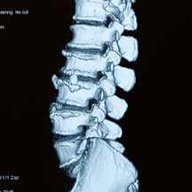 xray image of a spine