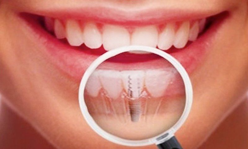 Opera di implantologia