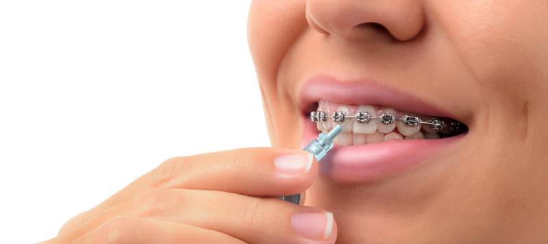 Apparecchio ortodontico