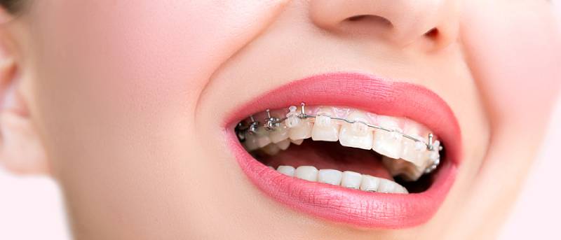 Apparecchio fisso con attacchi trasparenti