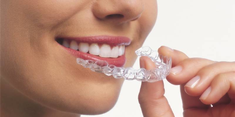 Apparecchio invisalign