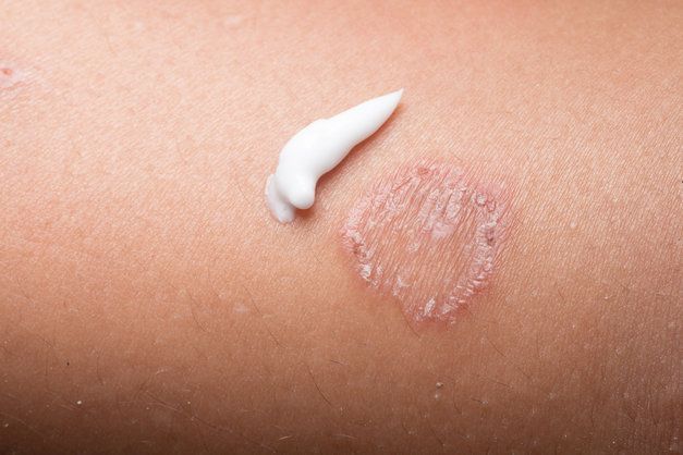 A person is applying cream to a rash on their arm.