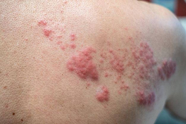 A close up of a person 's back with a rash on it.