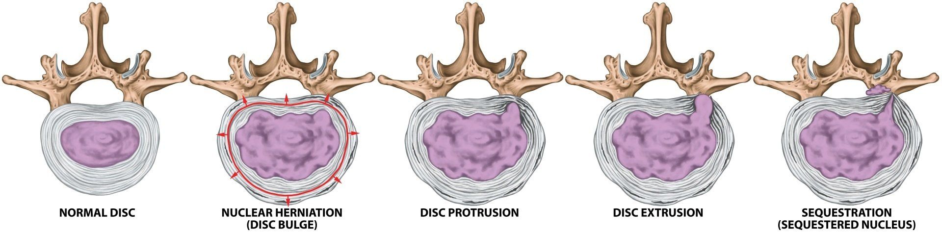 Different types of herniated disc