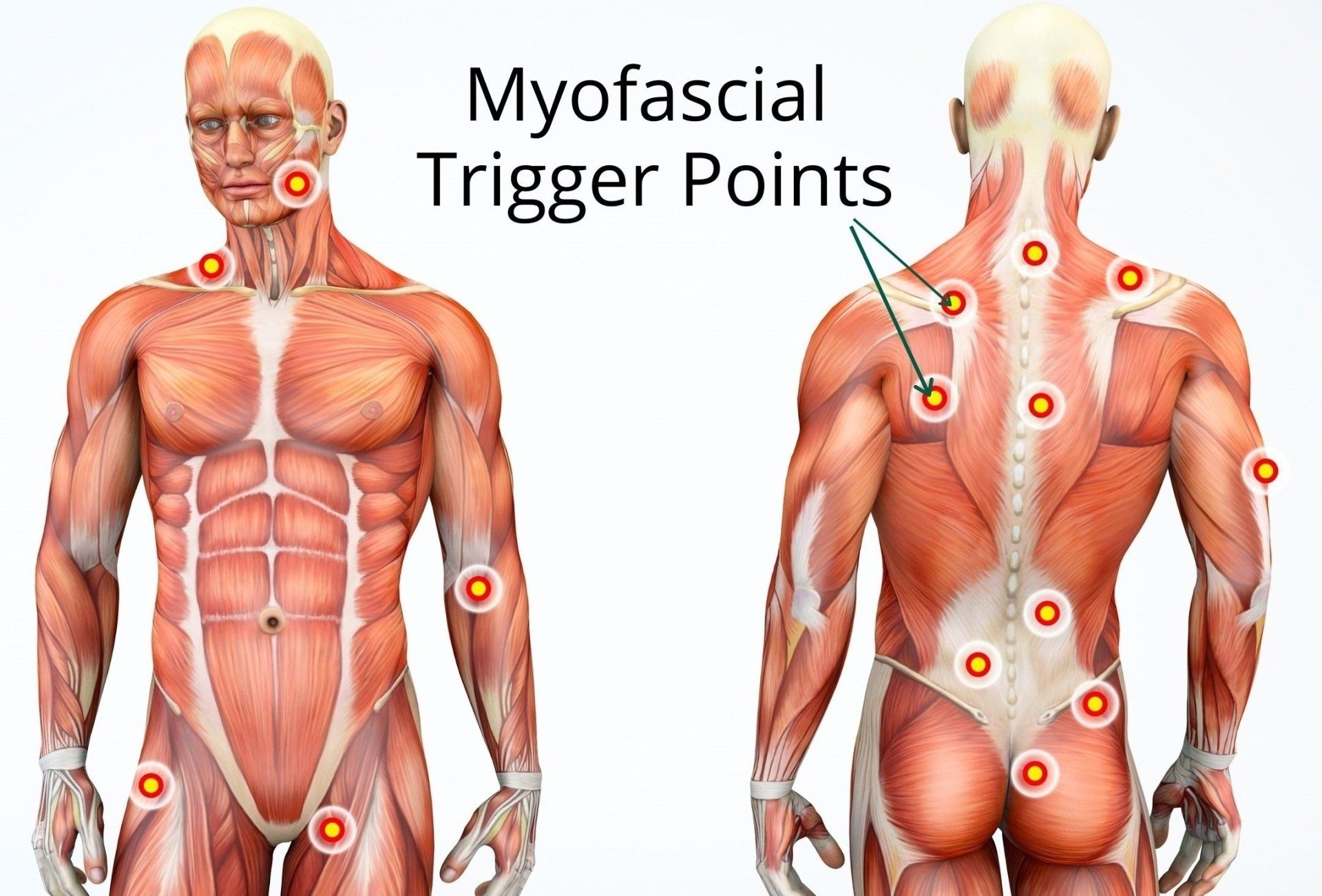 Muscle Knots And Myofascial Trigger Points