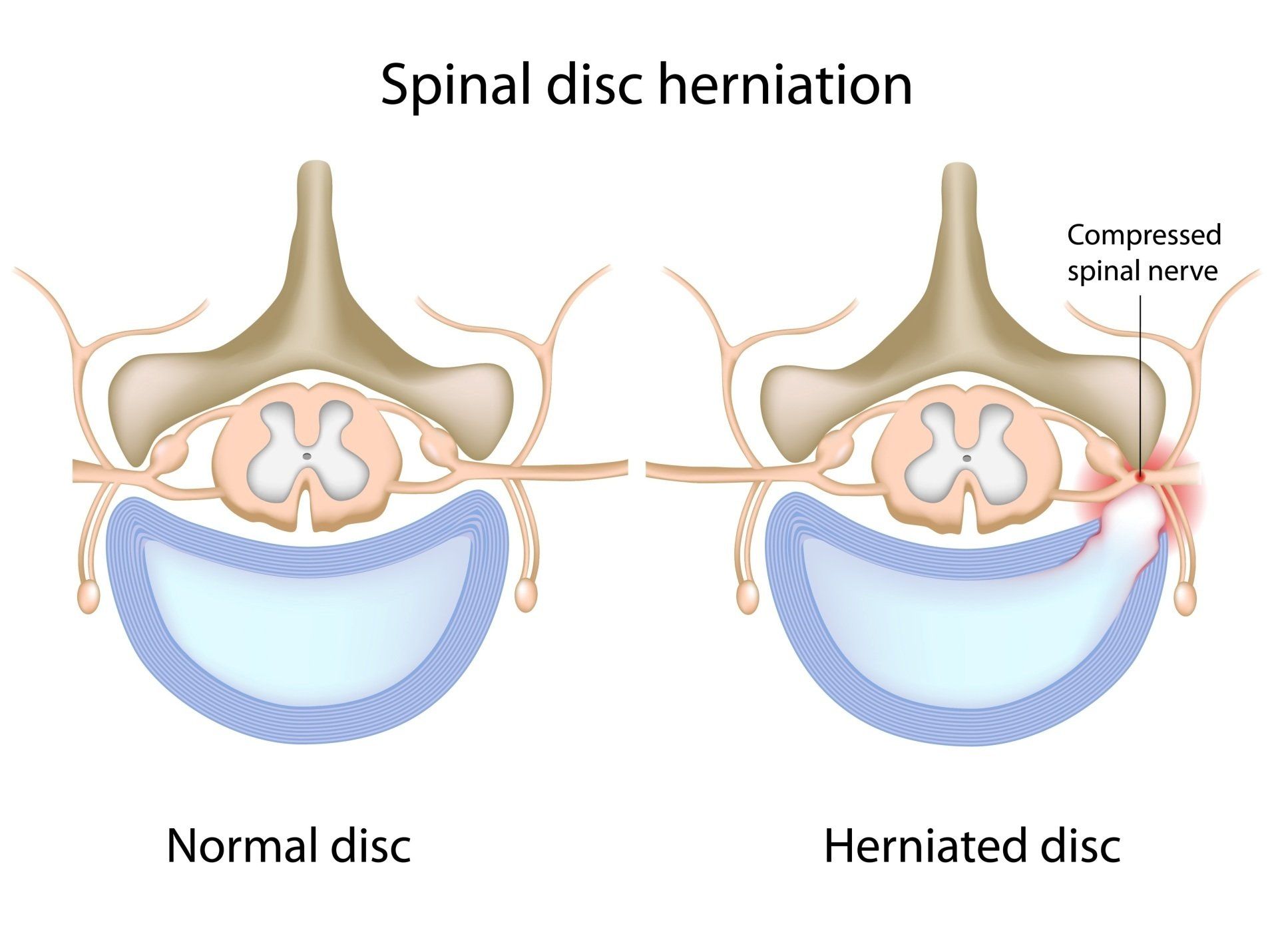 Herniated disc