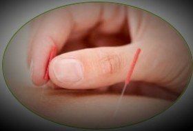 effectiveness of dry needling